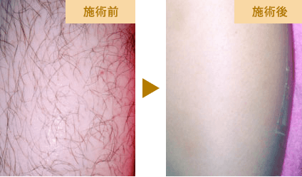 スネ脱毛の実例写真