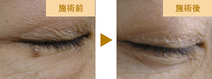 シミ取りの実例写真
