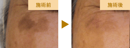 シミ取りの実例写真